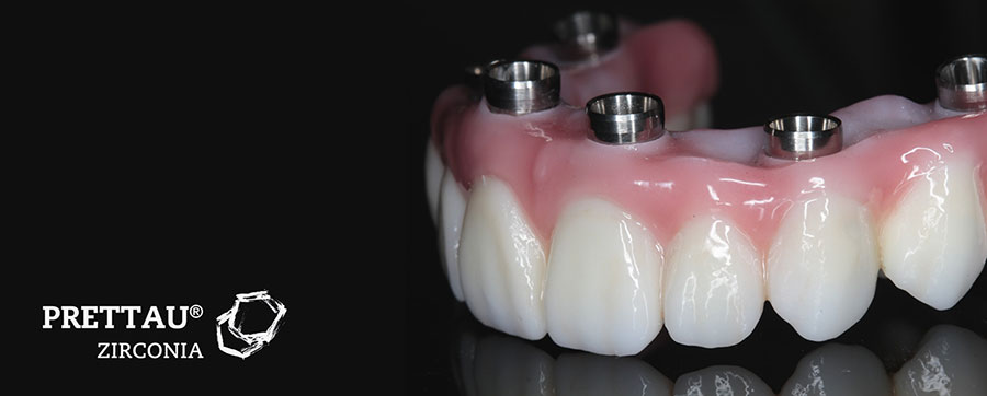 Prettau dental implant
