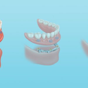 diagram of Removable mini implant dentures on Zest locators utilizing 2-6 dental implants