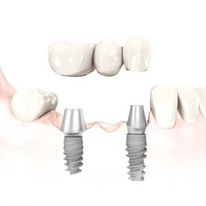 3 unit dental implant bridge