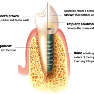 cross section diagram of a tooth implant